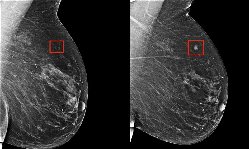 An AI system manage to identity the beginnings of a breast tumor four years before it developed (Yala)